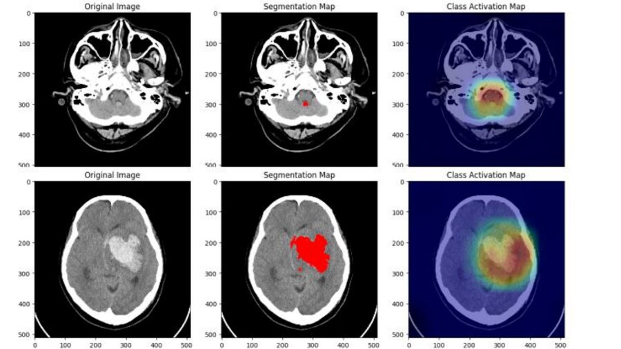 Brain CT hemorrhage segmentation and class-activation maps