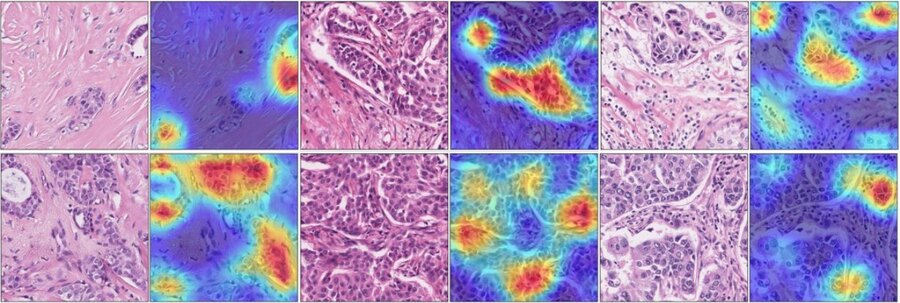 Grad-CAM heatmaps over H&E breast tissue patches