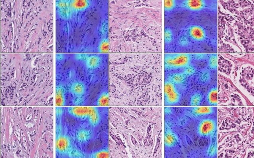 Class-activation maps for breast histologic grading